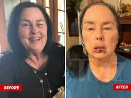 Duck Dynasty' Star Kay Robertson's Brutal Dog Bite Injuries