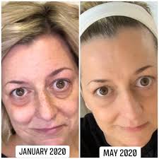 Help Please Oh acne why it so itchy . What are the prevention tips for  acne🥴😵‍💫 Is this part of aging ? I am 42 yrs old and I never experience  this