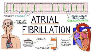 Image result for Atrial Fibrillation