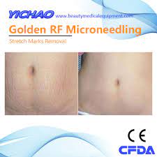 When the skin undergoes a period of stretch marks treatment before & after photos. China 2018 Rf Postpartum Recovery Stretch Marks Microneedling Therapy Medical Machine China Postpartum Recovery Machine Postpartum Recovery Medical Machine