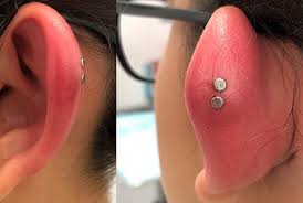 Before you can do that, you choose a clean, professional place to have your ears pierced. Swollen Cartilage Piercings Causes Treatment Authoritytattoo