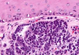 Merkel cell polyomavirus — virus classification group: Case Report Merkel Cell Carcinoma Patients Respond To Investigational Combination Therapy Consult Qd