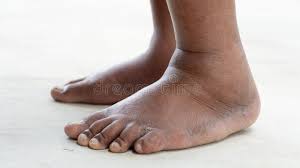 Image result for toe black diabetes