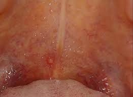 There can be many reasons for having bumps in your mouth. Blister On Roof Of Mouth Coldsores