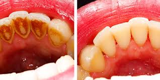 Dental plaque on teeth hardens to tartar if it's not removed properly. How To Remove Dental Plaque Coastal Dental Care