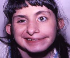 CHARGE 101: Diagnosis, Features, and the Importance of Sensory Deficits