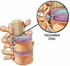 A slipped disk may cause symptoms such as pain down the back of the leg (sciatica), numbness, or weakness. Lumbar Discectomy Performed In An Outpatient Surgical Setting