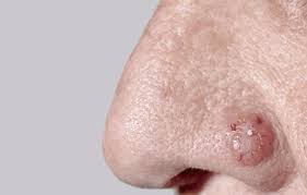 Malignant tumor on a nose (nasal cancer) destroys tissues and bone cavity on the face around nose, can cause the exact causes of the development of a cancer in the nasal cavity are not known to medicine. Basal Cell Carcinoma Nose Picture Image On Medicinenet Com