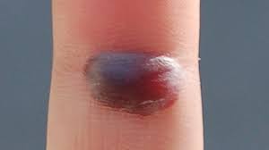 Read full article on dyshidrotic eczema. Blood Blister Symptoms Causes Diagnosis
