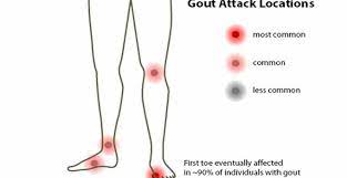 Gout occurs when excess uric acid (a normal waste product) collects in the body, and needle‐like urate crystals deposit in the joints. Uric Acid And Seven Ways To Reduce It Goqii