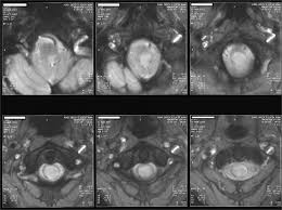 Image result for Syringomyelia