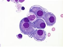 mesothelioma is a cancer of the lung linings that contains such cells. Mesothelial Cells Reactive Springerlink