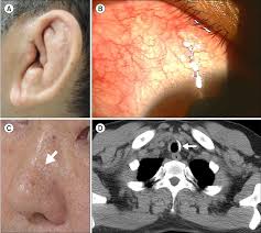 Image result for Relapsing Polychondritis