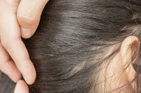 Image result for lice vs dandruff