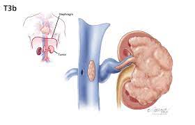 The present study has several limitations. Kidney Cancer Symptoms Diagnosis Treatment Urology Care Foundation