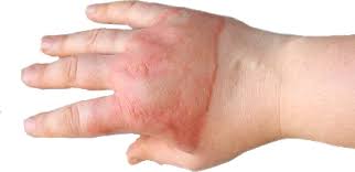 We did not find results for: Hand Injury Claims How Much Compensation Can I Claim