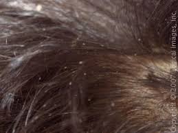 Image result for lice vs nits