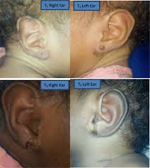 It's also possible that it could be oozing out pus. Necrotizing Soft Tissue Infection Of Both Ear Lobules Occurring Concomitantly In A Set Of Twins Following Non Aseptic Ear Piercing A Case Report Bmc Pediatrics Full Text