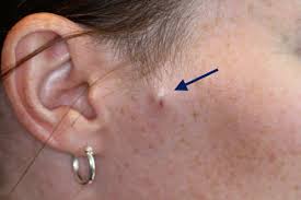 Image result for Relapsing Polychondritis