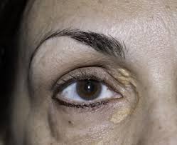 Image result for xanthelasma of eyelid