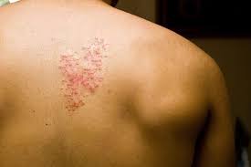 يسبب ظهور مرض الحزام الناري هو فيروس الهيربس كما ذكرنا فى التعريف ، وهو عباره عن الفيروس الذى يسبب مرض الجديرى (varicella) فى سن صغير لذلك يظهر عند الاطفال بشكل جدرى الماء ويكمن فى الاعصاب سنوات عديدة ليظهر فى سن الكبر على شكل الحزام الناري. ØªØ°ÙƒØ§Ø±ÙŠ Ù‚Ø·Ø§Ø± Ù…Ø²ÙŠØ¬ Ù…Ø§ Ø§Ù„Ø­Ø²Ø§Ù… Ø§Ù„Ù†Ø§Ø±ÙŠ Guillotinpoilvet Com