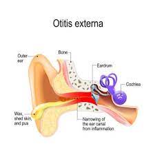 How Swimmer S Ear Can Lead To Temporary Hearing Loss