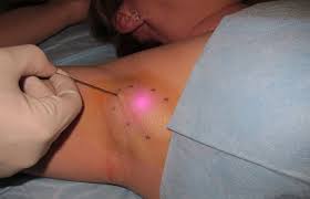 Koltuk Alti Asiri Terleme Ve Koku Problemlerinde Lazer Lipolizis