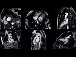 Image result for Cardiac MRI