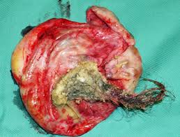Hair, bones and teeth inside ovarian cyst! Dermoid Cyst Melaka Fertility