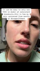 I dealt with an extremely frustrating breakout around my nose for four  months this last fall/winter and it was extremely disappointing ESPECIALLY  when you teach skincare and cosmetics weekly for ...