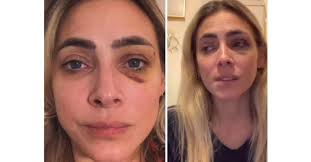 Edna Monroy acusa al cuñado de Jacky Bracamontes de agredirla, comparte  fotos de las lesiones que sufrió