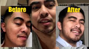 If the hair follicles are not in a long term dormant phase there is. Minoxidil Beard Result After 3 Bottles Asian Man Using Kirkland Minoxidil 5 Youtube