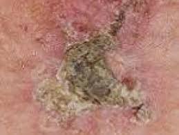 Avoiding the sun and using sunscreen may help protect against basal cell carcinoma. What Are The Types Of Non Melanoma Skin Cancer Irish Cancer Society