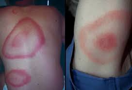 Image result for infected tick bite