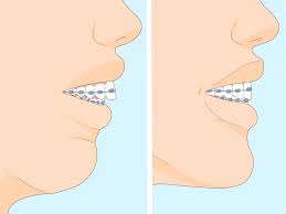 How to fix an overbite. 7 Ways To Fix An Overbite Wikihow