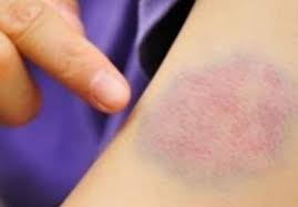 Ovo stanje, i neugodno i neugodno, ako se ne riješi na vrijeme, može dovesti do gubitka nokta, koji će pasti kada počne rast novog. Modrica Na Tijelu A Niste Se Nigdje Udarili Evo Na Sta Upucuje Ovaj Simptom Obratite Paznju Bolja Bosna