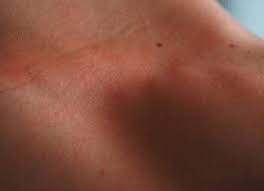 Irritations Les Eviter Et Les Apaiser Symptomes Et Traitements