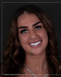 Dental Design Turkey Antalya (@dentaldesignturkey) · Instagram 照片和视频