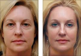One Of The Most Common Beauty Problems Women Face These Days Is Black Circles Under Their Eyes There Are Manu Reasons Which Ca Skin Care Undereye Healthy Skin