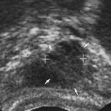El libertino invisible pdf mirror link #1. Local Recurrence After Radical Prostatectomy Correlation Of Us Features With Prostatic Fossa Biopsy Findings Radiology
