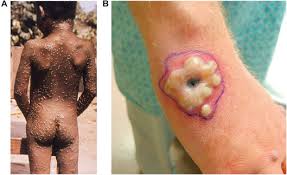Monkeypox is taking a short break. Monkeypox Virus An Overview Sciencedirect Topics