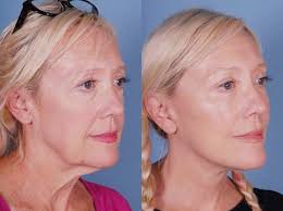 What Is A Mini Face Lift And How Much Does It Cost Mini Face Lift Face Lift Cost Face Lift Surgery