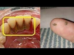 Beberapa orang mengaku gusi bengkak memang sangat menyiksa. 8 Cara Mudah Hilangkan Karang Gigi Tanpa Harus Pergi Ke Dokter Gigi Youtube Gigi Kedokteran Gigi Resep