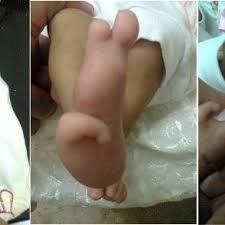 For language access assistance, contact the ncats public information officer. A Boy With Pallister Hall Syndrome Who Had Imperforate Anus At Birth Download Scientific Diagram