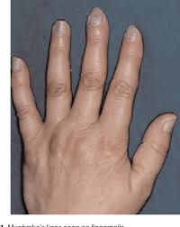 Image result for Muehrcke Line