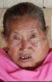 Yasmina's house in Syria was hit and shell fragments got stuck in her left  eye. Her father lost his legs and her sister was also injured by the  bombing. Doctors removed the