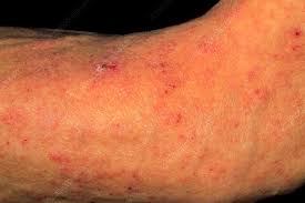 Image result for scabies bite