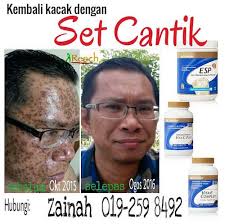 Read more about chickenpox symptoms and when to get medical advice. Parut Chicken Pox Di Usia 43 Tahun Hilang Dengan Bantuan Suplemen Genkimomma My