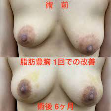 垂れ乳（乳房下垂）と豊胸手術 | 脂肪豊胸専門の銀座3丁目•BANNAI美容クリニック