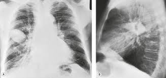 Localized interlobar effusions in congestive heart failure (phantom or vanishing lung tumor/s) is/are uncommon but well known entities. 15 Pleura And Pleural Disorders Radiology Key